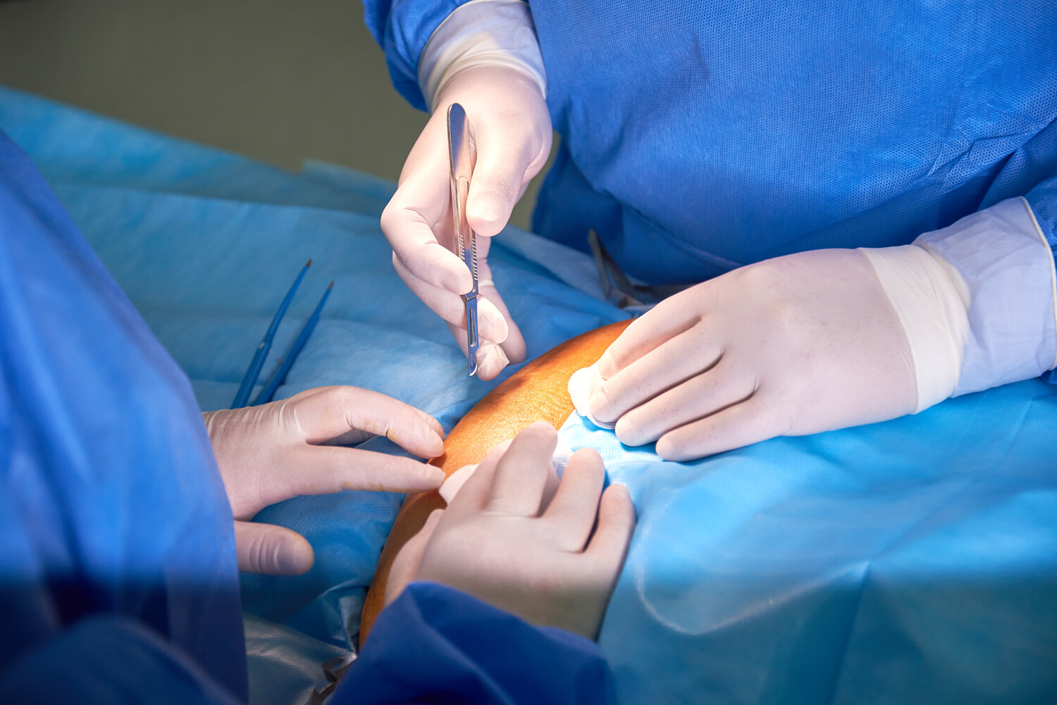 На изображении хирурги в синих халатах проводят эндоскопическую операцию. Видны руки врачей, инструменты и яркий свет на коже пациента.