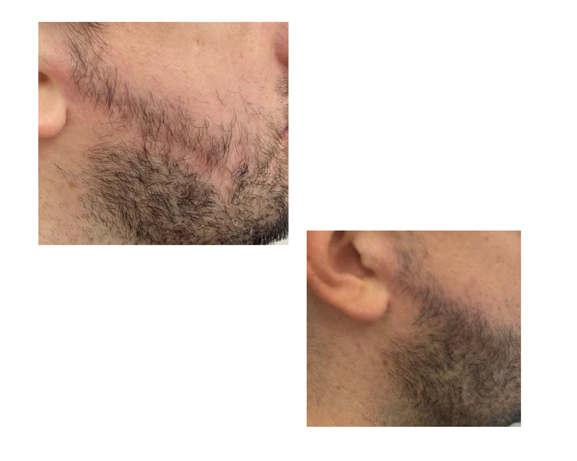 На изображениях результаты до и после пересадки волос в область шрама на бороде